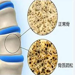 【骨密度分析儀科普】骨密度指標(biāo)對(duì)照表，人手一份