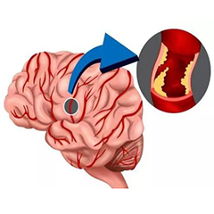 經(jīng)顱多普勒廠(chǎng)家告訴你15個(gè)腦中風(fēng)的誤區(qū)
