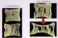 哪些人群需重點關注骨密度檢查，需及時補鈣