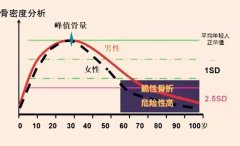 骨密度難防又難治 科學補鈣講究方法