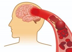 腦供血不足可檢查、可逆轉(zhuǎn)嗎