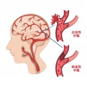 了解腦血管病的防治策略